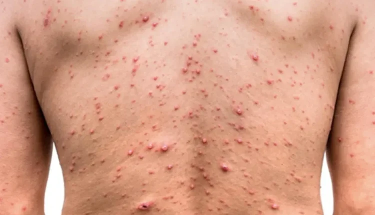 Mpox en San Juan: el caso fue importado y no se detectaron nuevos contagios
