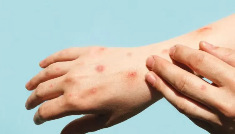 Salud: detectaron cuatro nuevos casos de Mpox en Argentina y ya son 15 los confirmados en el año