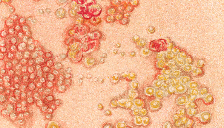 Cuál es la infección que aumenta más de 30% el riesgo de infarto y ACV
