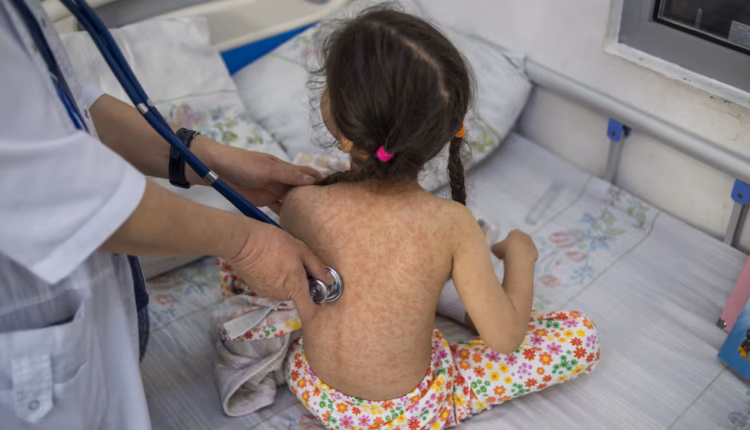 Nueva York declara emergencia sanitaria por sarampión